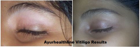 Vitiligo treatment Australia