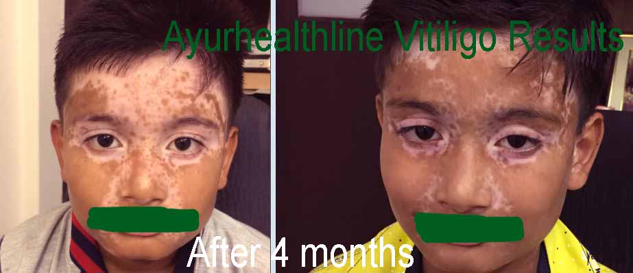 vitiligo on face