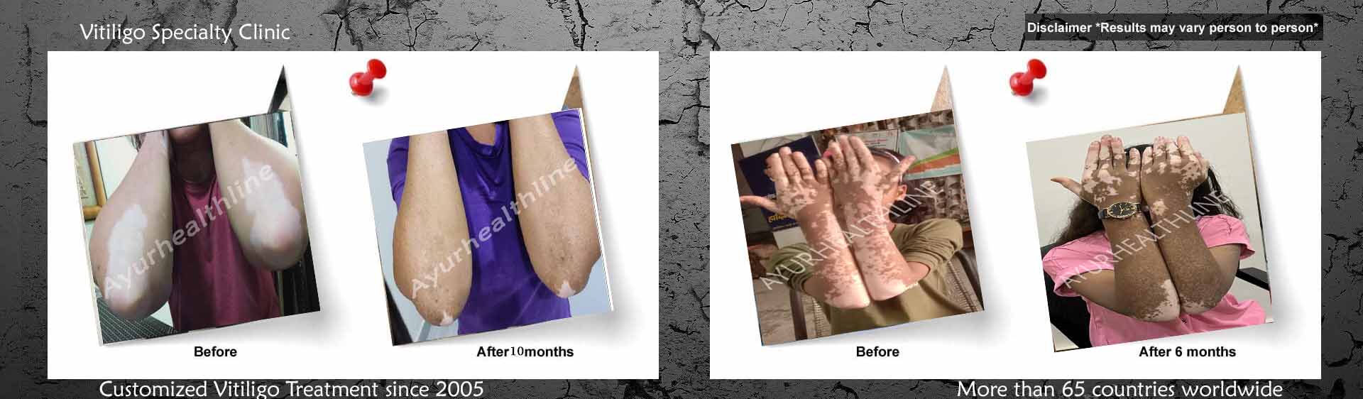 vitilig_treatment_USA
