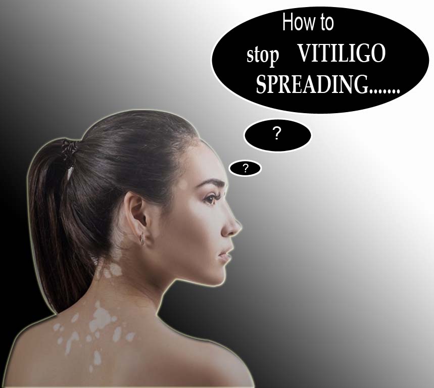 How To Stop Vitiligo Spreading How To Control Vitiligo Spreading